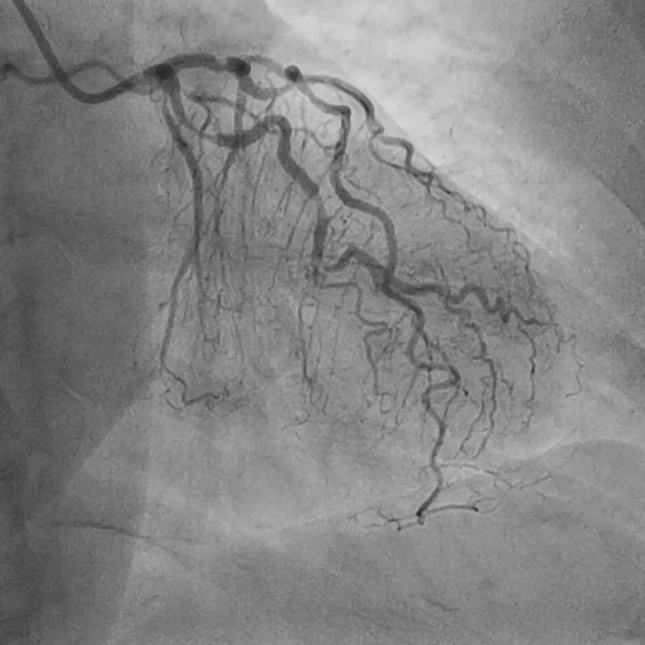 Understanding Coronary Angiography
